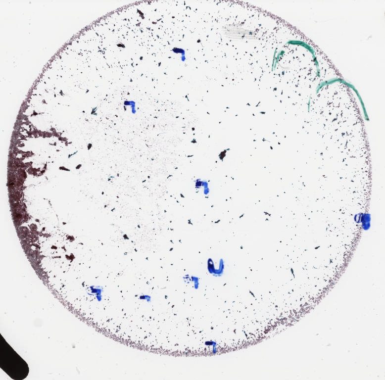 icd 10 ascus hpv positive